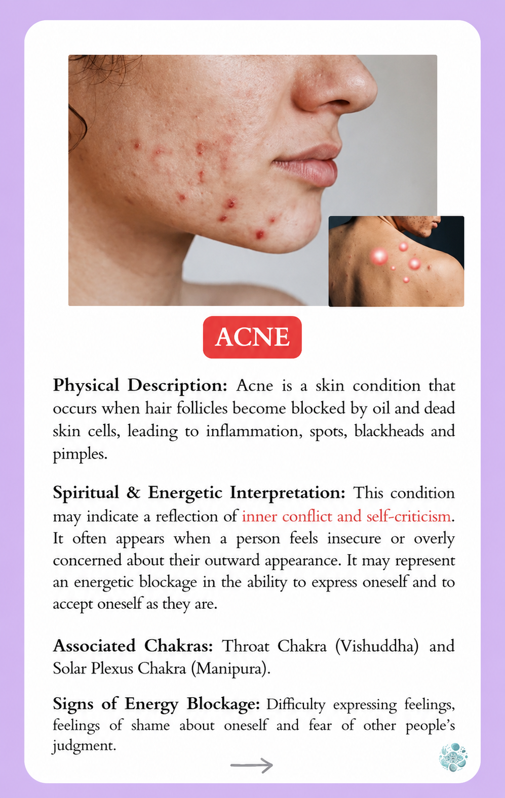Preview: Acne